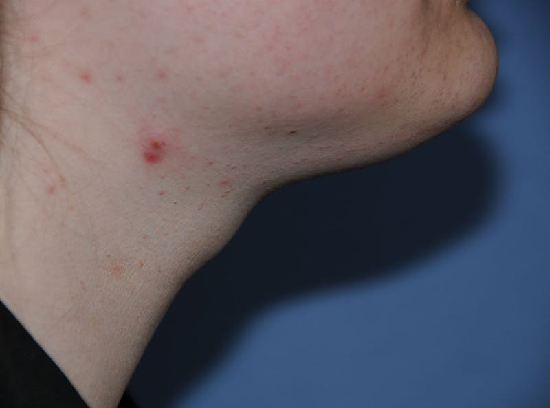 Transgender Surgery Before & After Gallery - Patient 296177 - Image 5