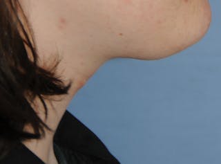 Transgender Surgery Before & After Gallery - Patient 296177 - Image 6