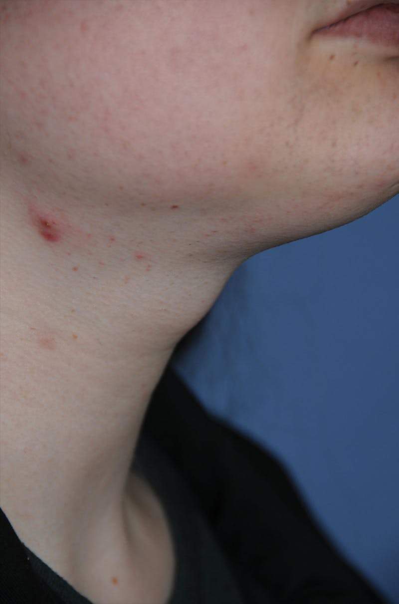Transgender Surgery Before & After Gallery - Patient 296177 - Image 7