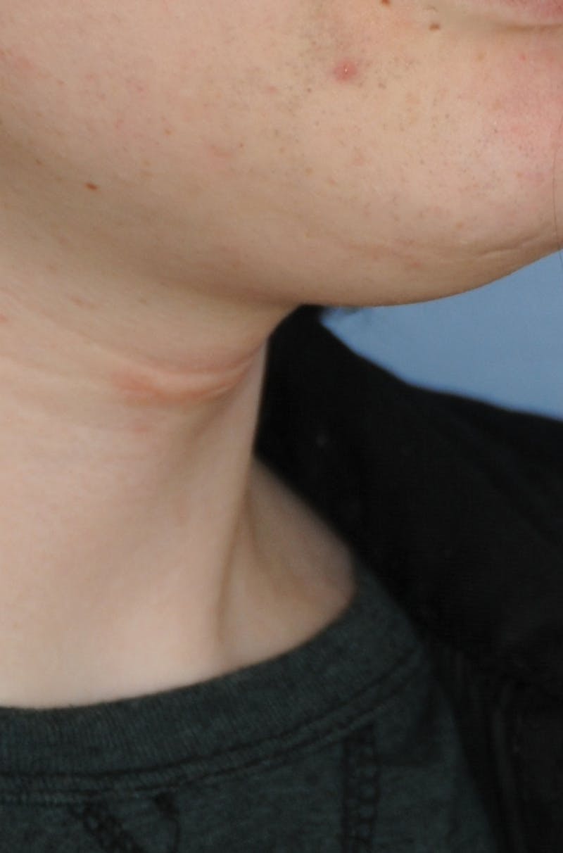 Transgender Surgery Before & After Gallery - Patient 296177 - Image 8