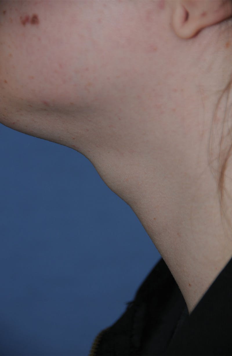 Transgender Surgery Before & After Gallery - Patient 296177 - Image 9