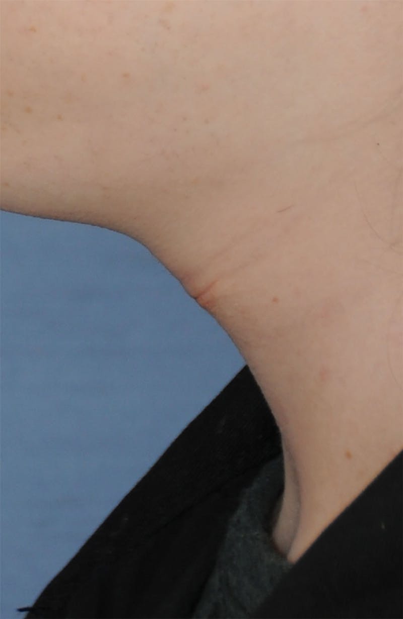 Transgender Surgery Before & After Gallery - Patient 296177 - Image 10