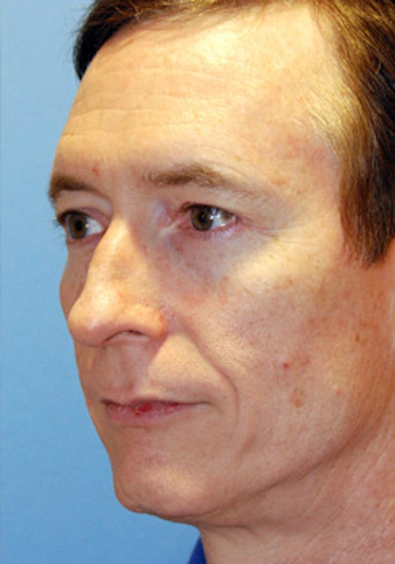 Transgender Surgery Before & After Gallery - Patient 296677 - Image 3