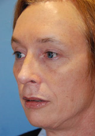 Transgender Surgery Before & After Gallery - Patient 296677 - Image 4