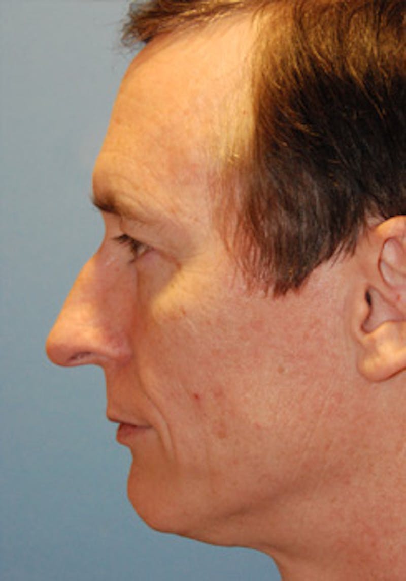 Transgender Surgery Before & After Gallery - Patient 296677 - Image 5