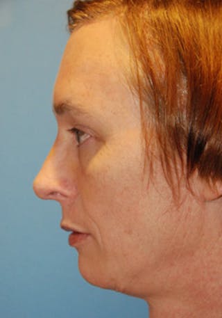 Transgender Surgery Before & After Gallery - Patient 296677 - Image 6