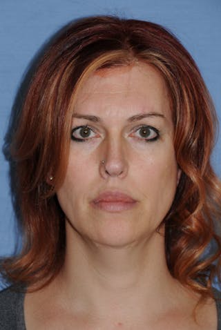 Transgender Surgery Before & After Gallery - Patient 270382 - Image 2