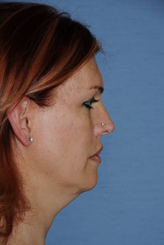 Transgender Surgery Before & After Gallery - Patient 270382 - Image 4