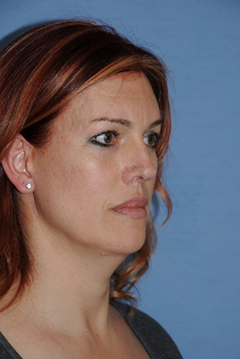 Transgender Surgery Before & After Gallery - Patient 270382 - Image 6