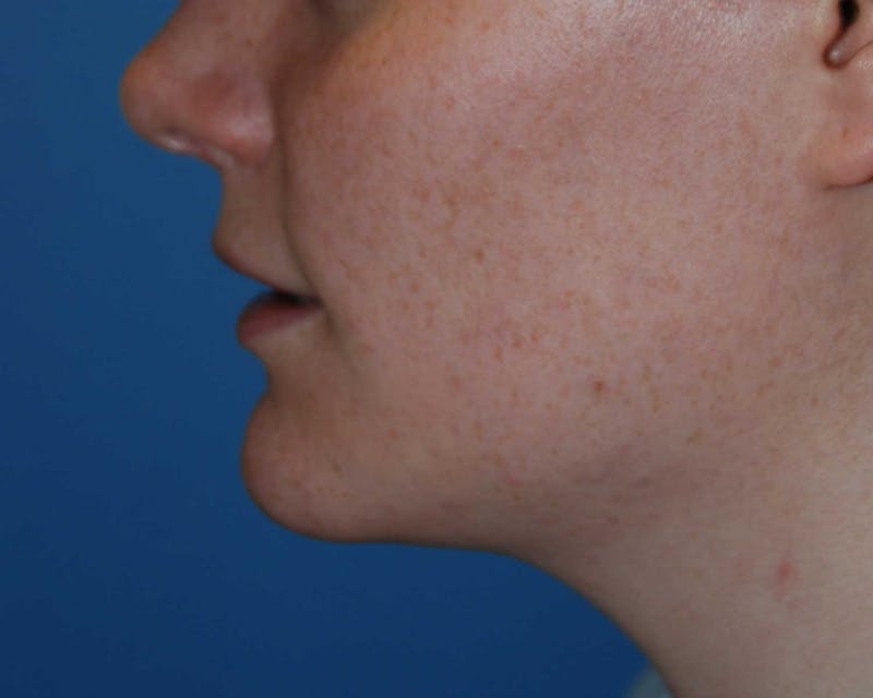 Transgender Surgery Before & After Gallery - Patient 940998 - Image 1