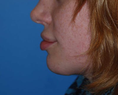 Transgender Surgery Before & After Gallery - Patient 940998 - Image 2
