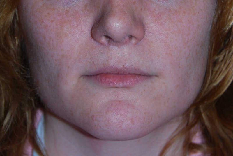 Transgender Surgery Before & After Gallery - Patient 187711 - Image 1