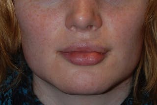 Transgender Surgery Before & After Gallery - Patient 187711 - Image 2