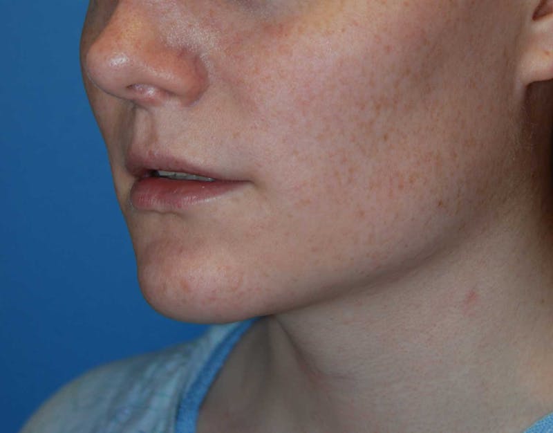 Transgender Surgery Before & After Gallery - Patient 187711 - Image 3