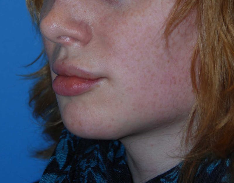 Transgender Surgery Before & After Gallery - Patient 187711 - Image 4