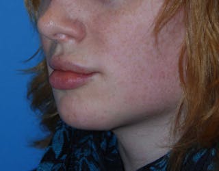 Transgender Surgery Before & After Gallery - Patient 187711 - Image 4