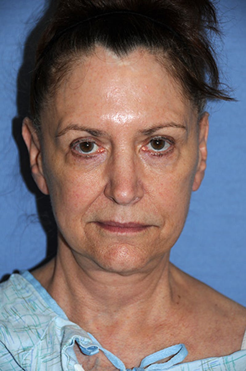 YoungVitalizer Before & After Gallery - Patient 329257 - Image 1