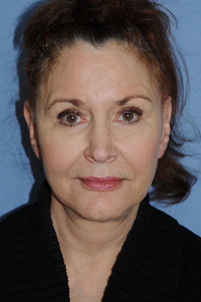 YoungVitalizer Before & After Gallery - Patient 329257 - Image 2
