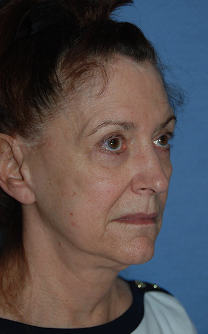 YoungVitalizer Before & After Gallery - Patient 329257 - Image 3