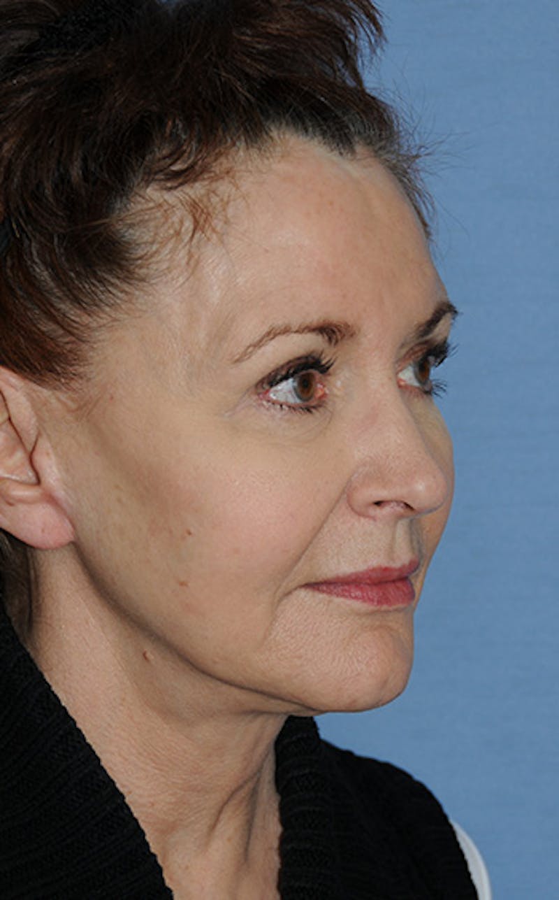 YoungVitalizer Before & After Gallery - Patient 329257 - Image 4