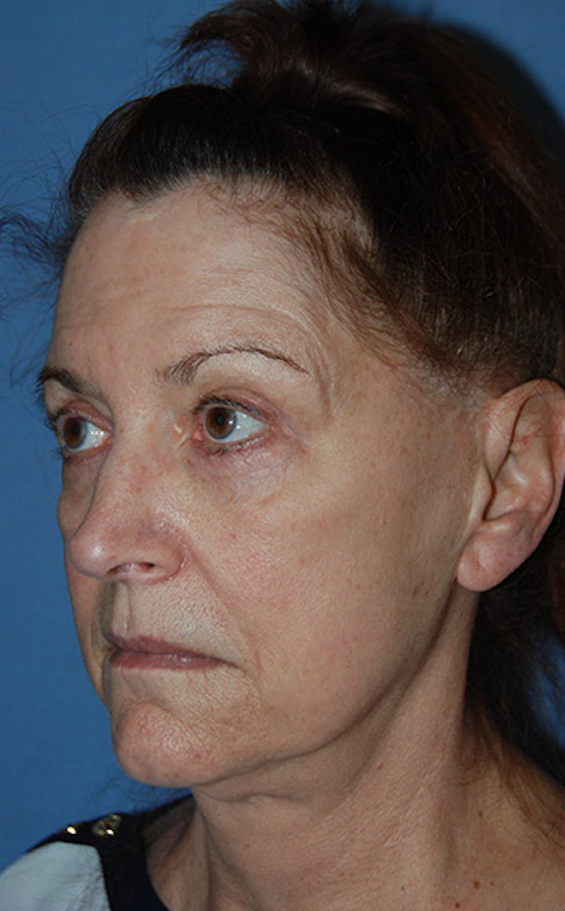 YoungVitalizer Before & After Gallery - Patient 329257 - Image 5