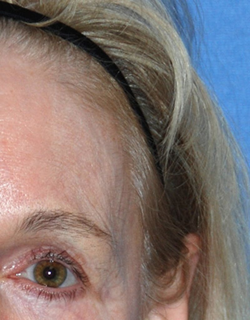 YoungVitalizer Before & After Gallery - Patient 191183 - Image 1