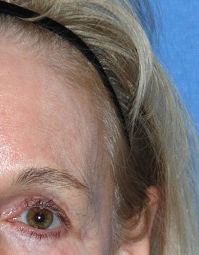 YoungVitalizer Before & After Gallery - Patient 191183 - Image 1