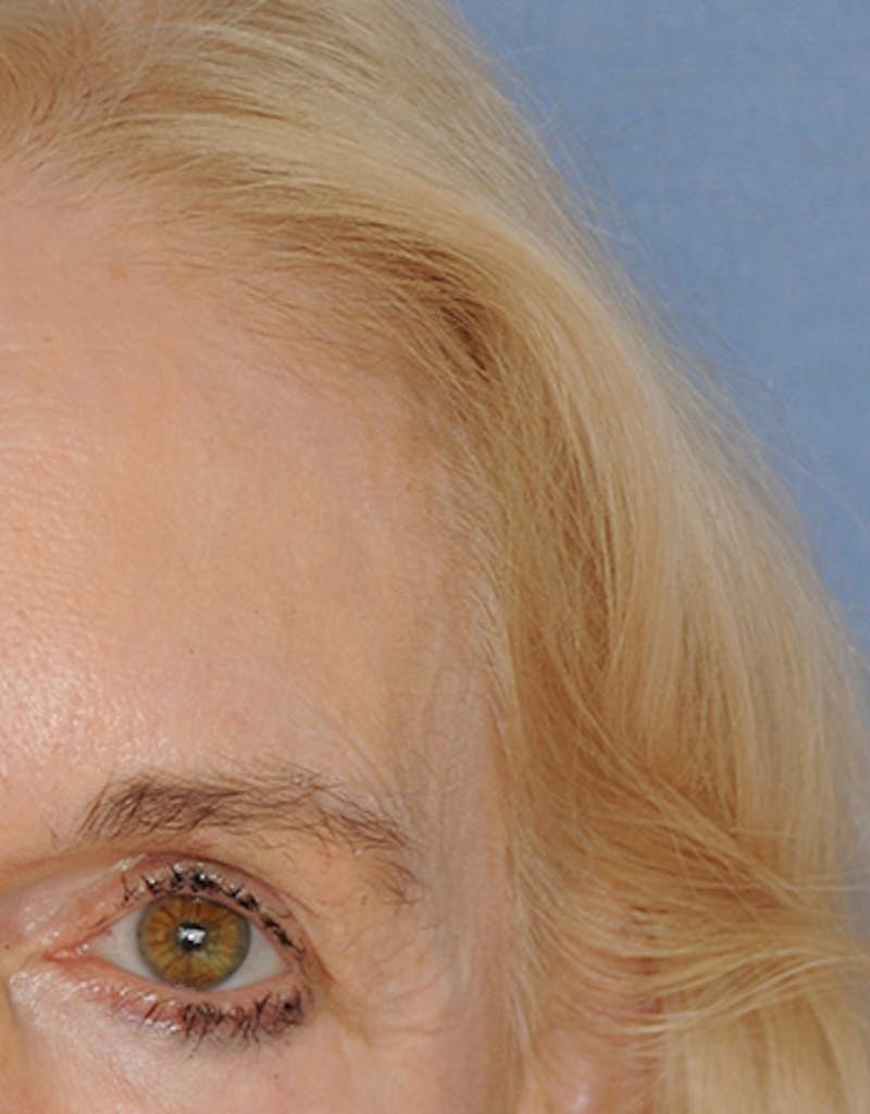 YoungVitalizer Before & After Gallery - Patient 191183 - Image 2