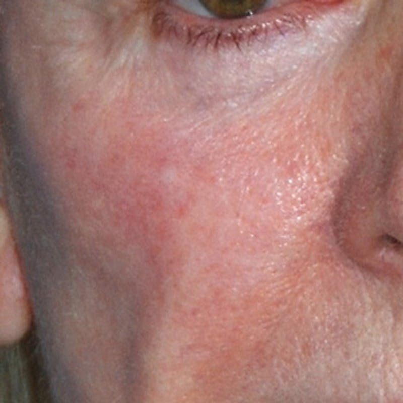 YoungVitalizer Before & After Gallery - Patient 191183 - Image 3