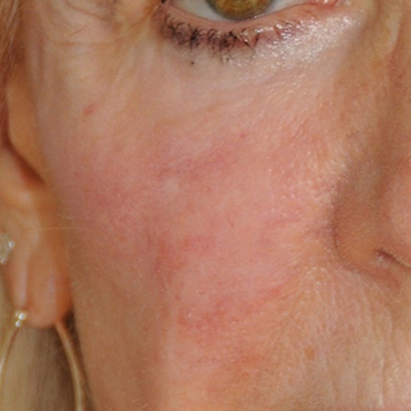 YoungVitalizer Before & After Gallery - Patient 191183 - Image 4