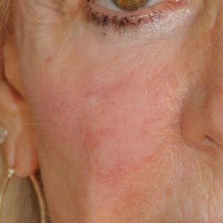 YoungVitalizer Before & After Gallery - Patient 191183 - Image 4