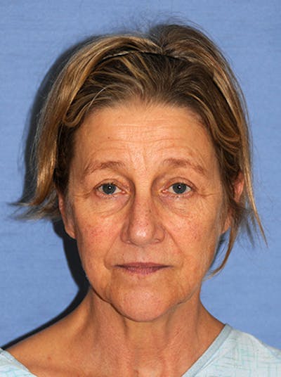 YoungVitalizer Before & After Gallery - Patient 299878 - Image 1