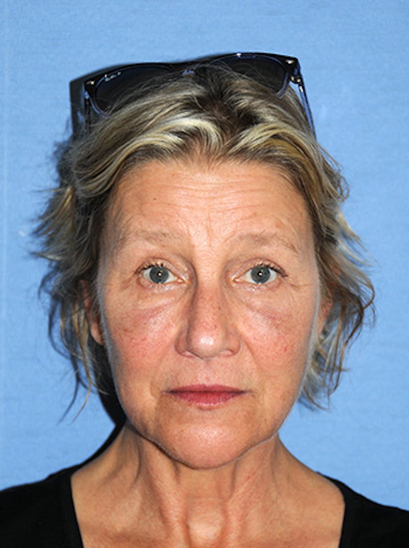 YoungVitalizer Before & After Gallery - Patient 299878 - Image 2