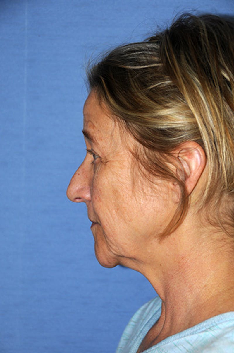 YoungVitalizer Before & After Gallery - Patient 299878 - Image 3