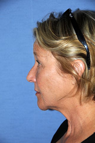 YoungVitalizer Before & After Gallery - Patient 299878 - Image 4