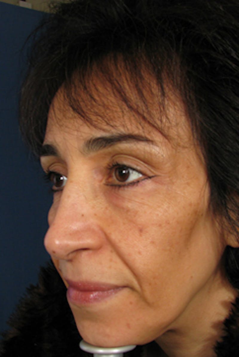 YoungVitalizer Before & After Gallery - Patient 228501 - Image 1