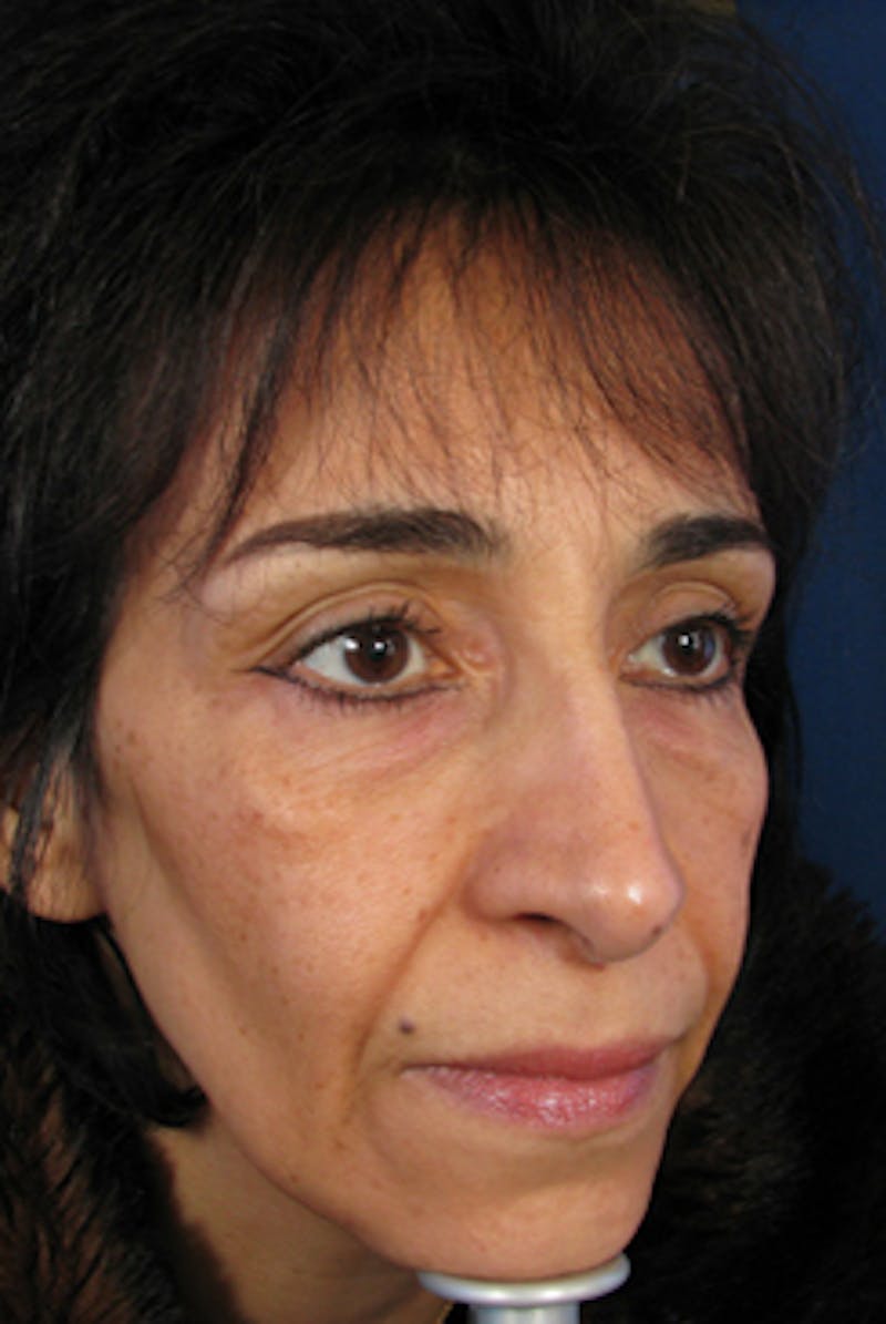 YoungVitalizer Before & After Gallery - Patient 228501 - Image 3