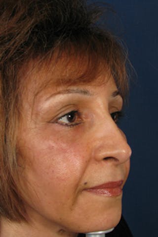 YoungVitalizer Before & After Gallery - Patient 228501 - Image 4
