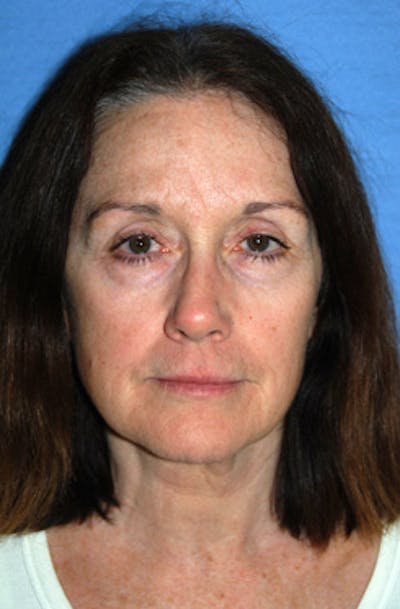 YoungVitalizer Before & After Gallery - Patient 294797 - Image 1