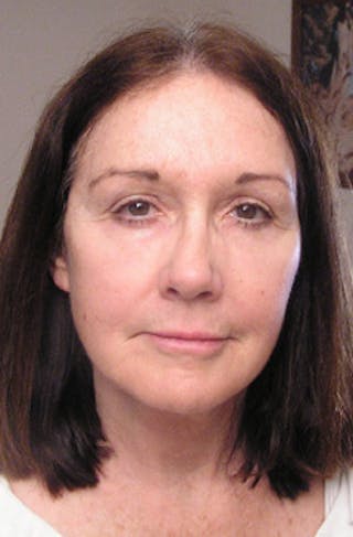 YoungVitalizer Before & After Gallery - Patient 294797 - Image 2