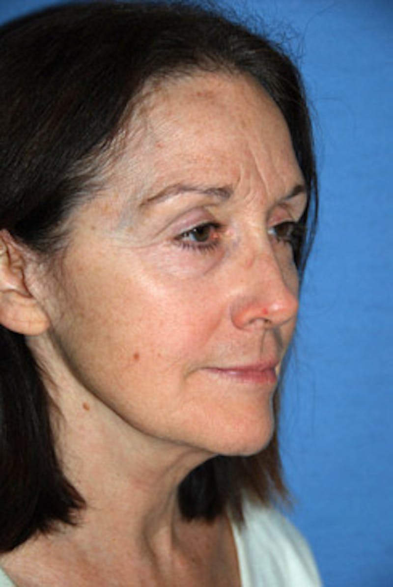 YoungVitalizer Before & After Gallery - Patient 294797 - Image 3