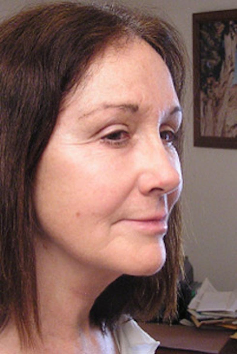 YoungVitalizer Before & After Gallery - Patient 294797 - Image 4