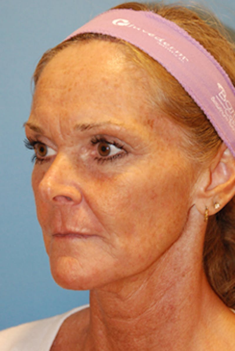 YoungVitalizer Before & After Gallery - Patient 164721 - Image 3