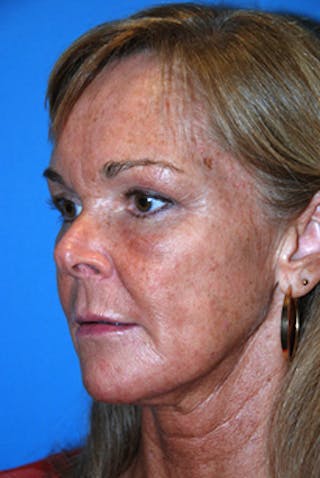 YoungVitalizer Before & After Gallery - Patient 164721 - Image 4