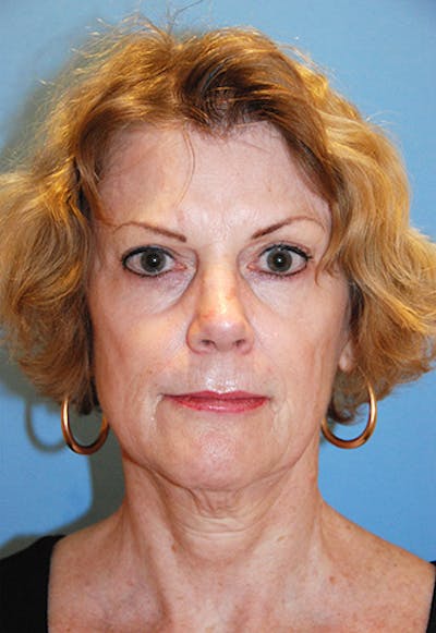 YoungVitalizer Before & After Gallery - Patient 238471 - Image 1