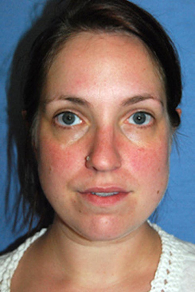 YoungVitalizer Before & After Gallery - Patient 738433 - Image 1