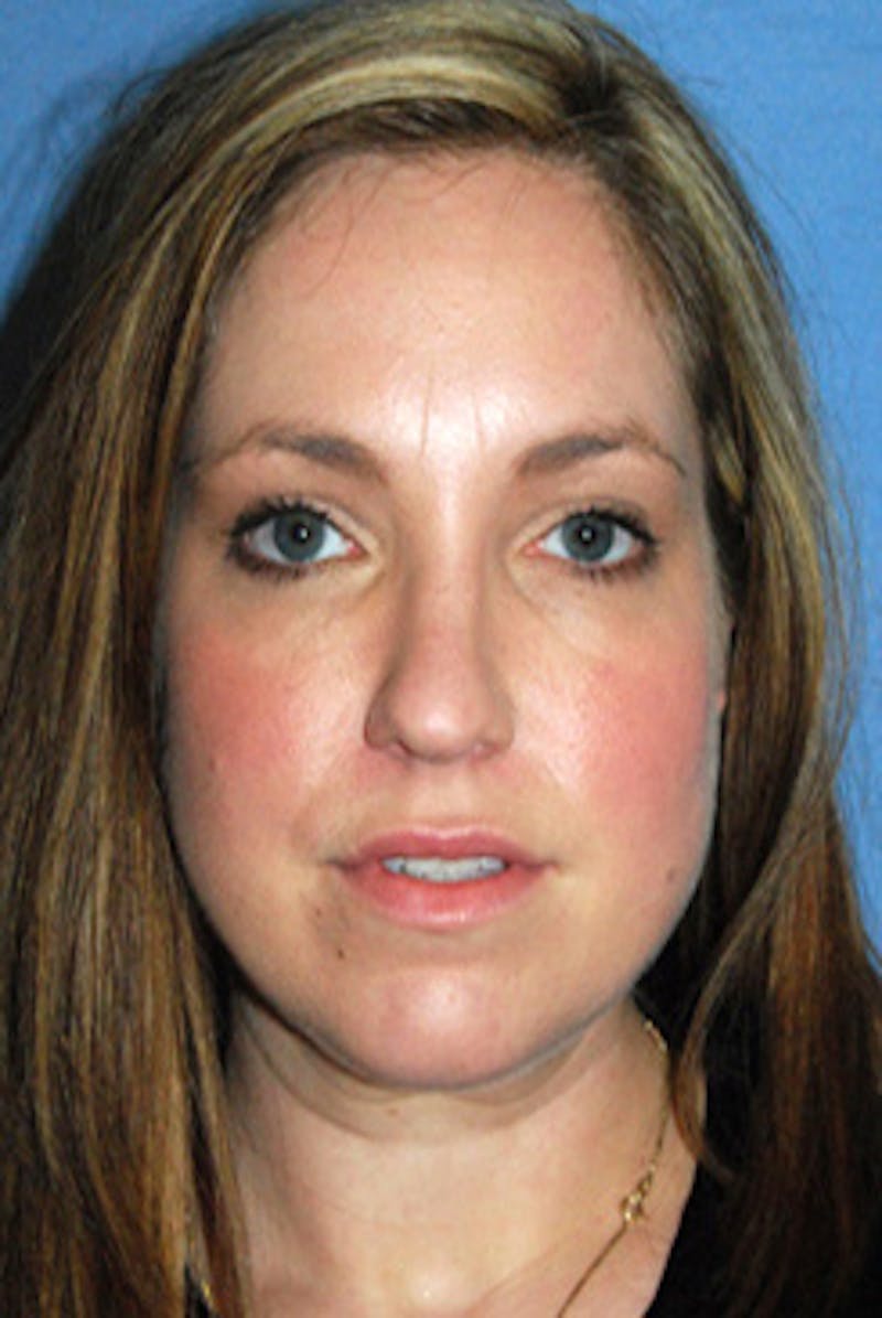 YoungVitalizer Before & After Gallery - Patient 738433 - Image 2