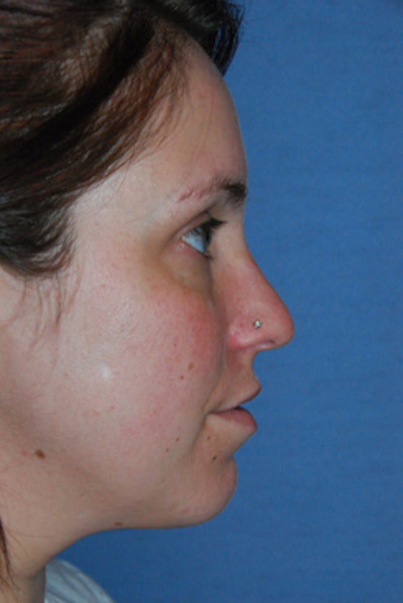 YoungVitalizer Before & After Gallery - Patient 738433 - Image 3