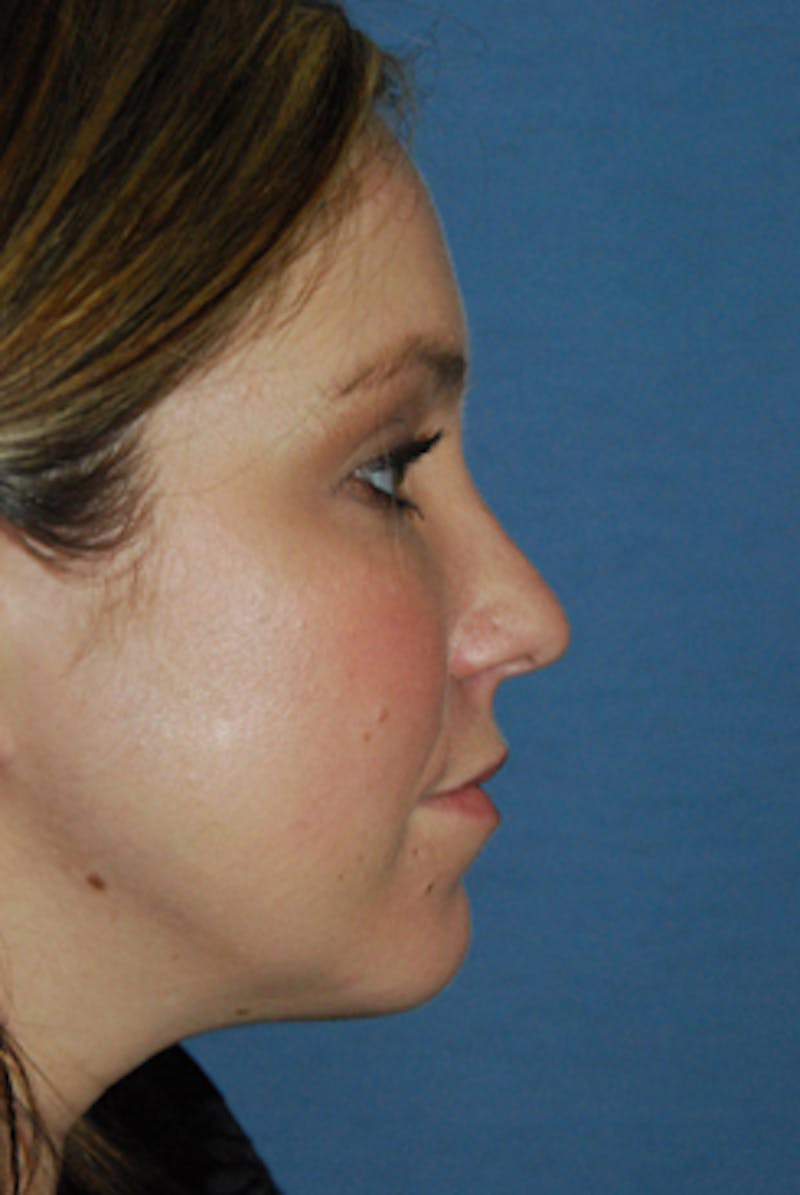 YoungVitalizer Before & After Gallery - Patient 738433 - Image 4