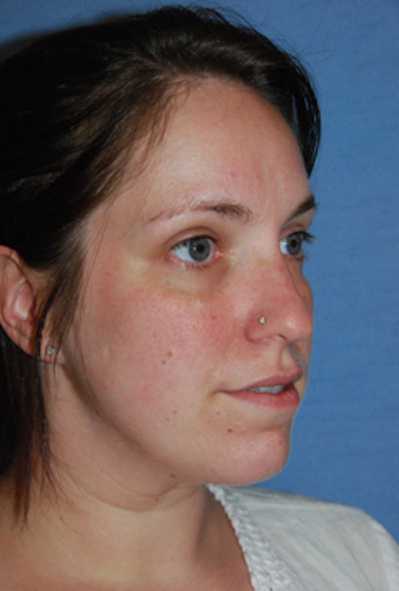 YoungVitalizer Before & After Gallery - Patient 738433 - Image 5